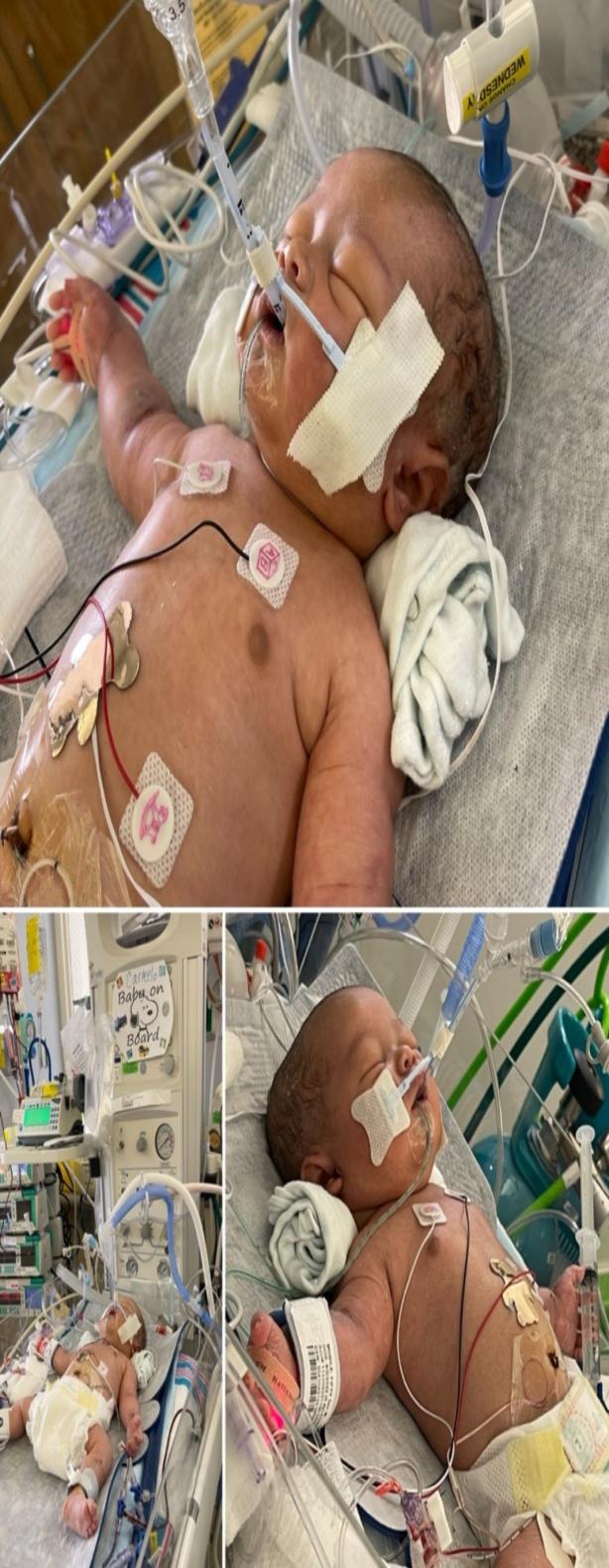 Birth Injury